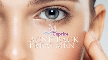 Acne Back Treatment